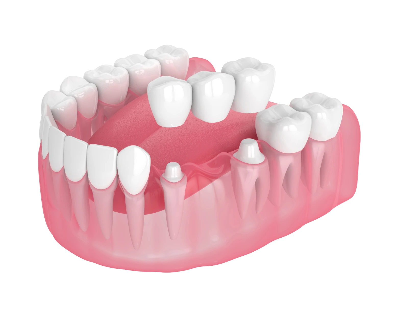3D model of a dental arch showcasing oral prostheses, including natural teeth and prosthetic elements, illustrating aesthetic and functional restoration for dental health.