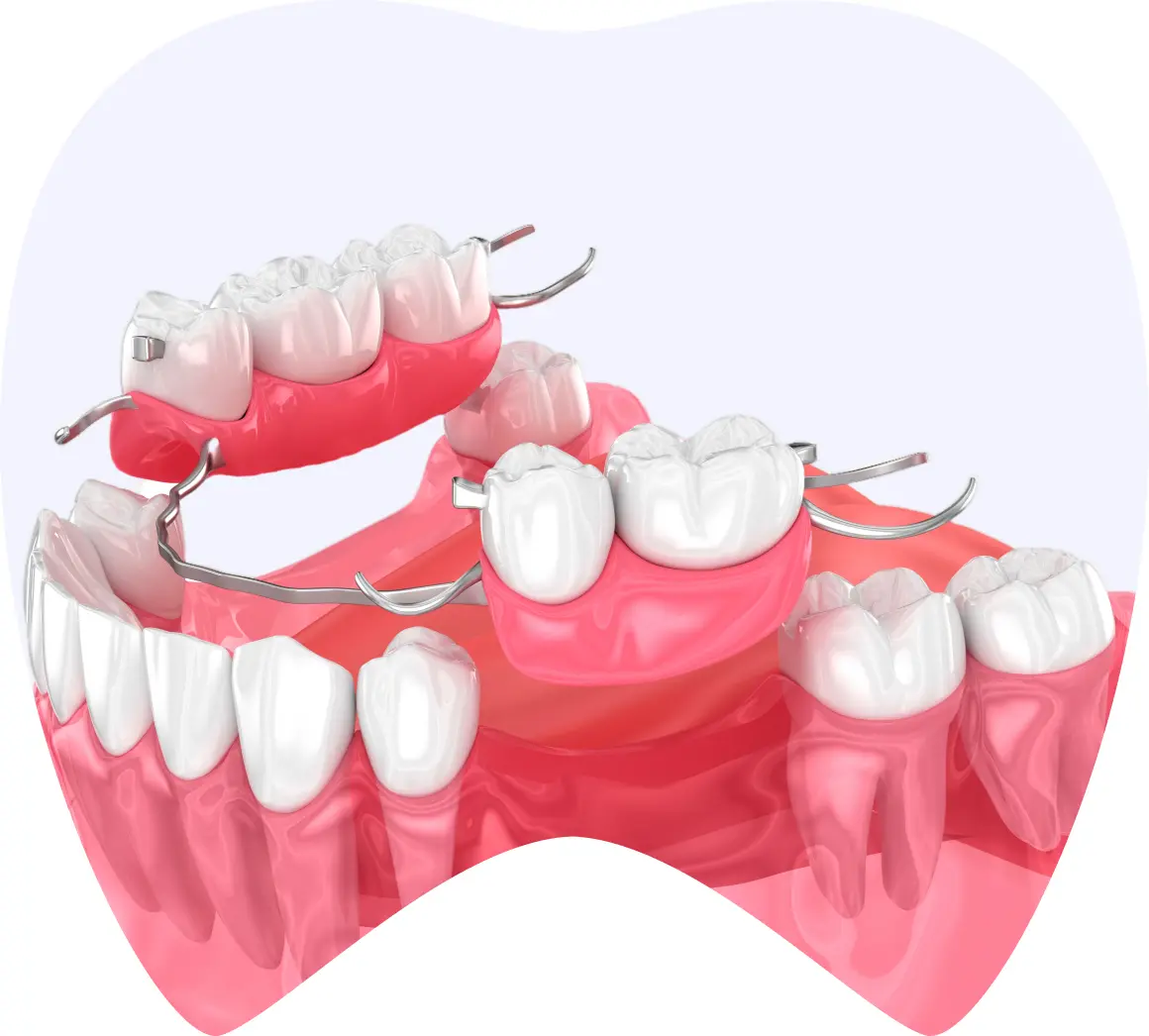 Dental prosthesis illustration showing fixed and removable options, highlighting esthetic and functional restoration for oral health.