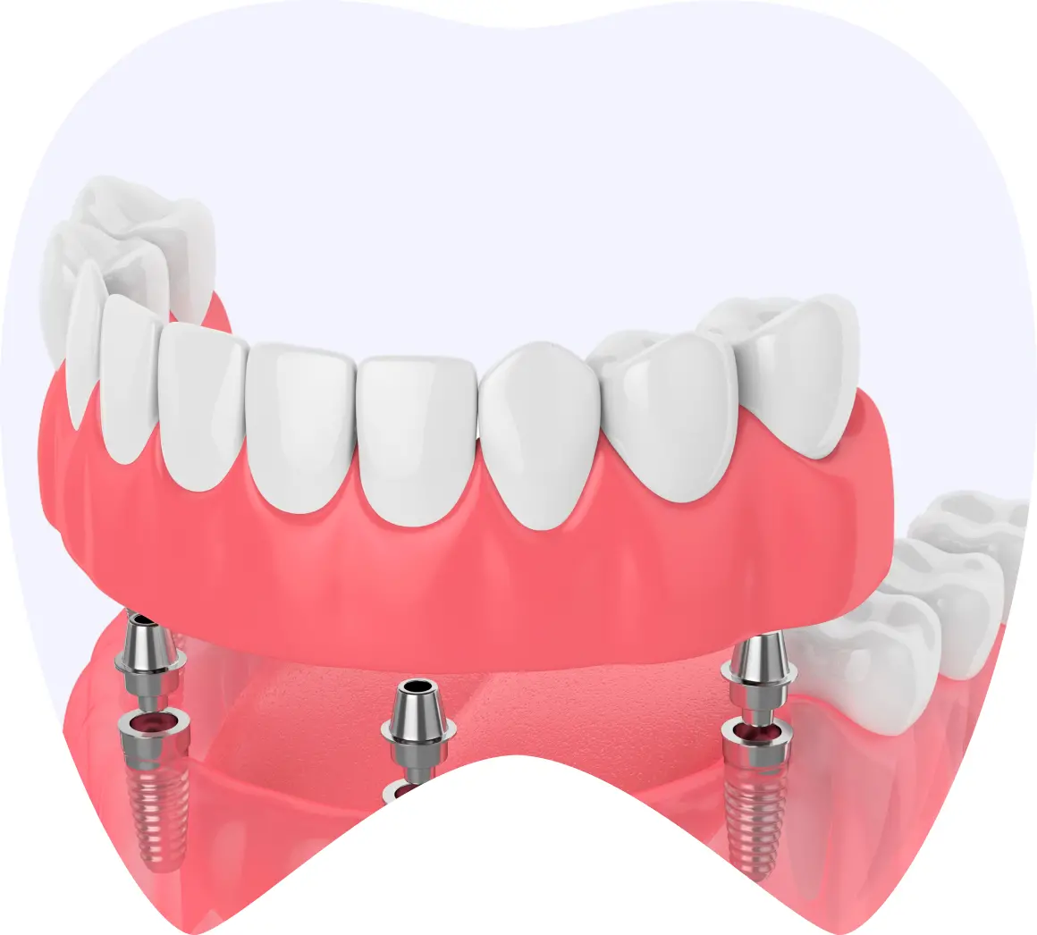Prosthetic dental arch with white teeth and pink gum base, showcasing implant fixtures for total prosthesis options at La Clínica Dental.