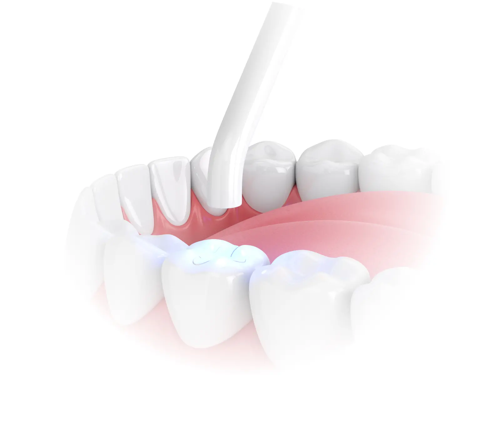 Dental procedure using high aesthetic resins on teeth, highlighting tooth restoration and cosmetic enhancement.